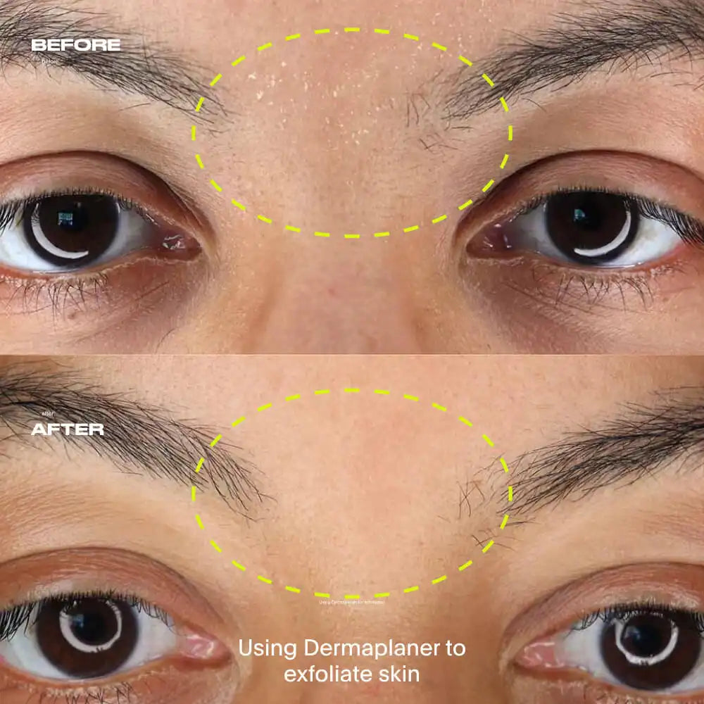 Dermaplaner Kit, Fig